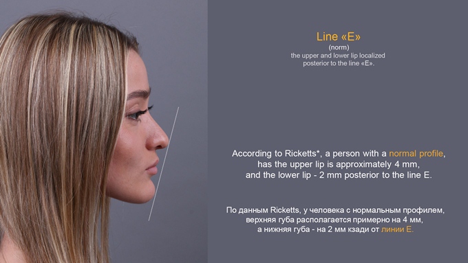 Digital Smile Design: опыт модели Елены Костиковой
