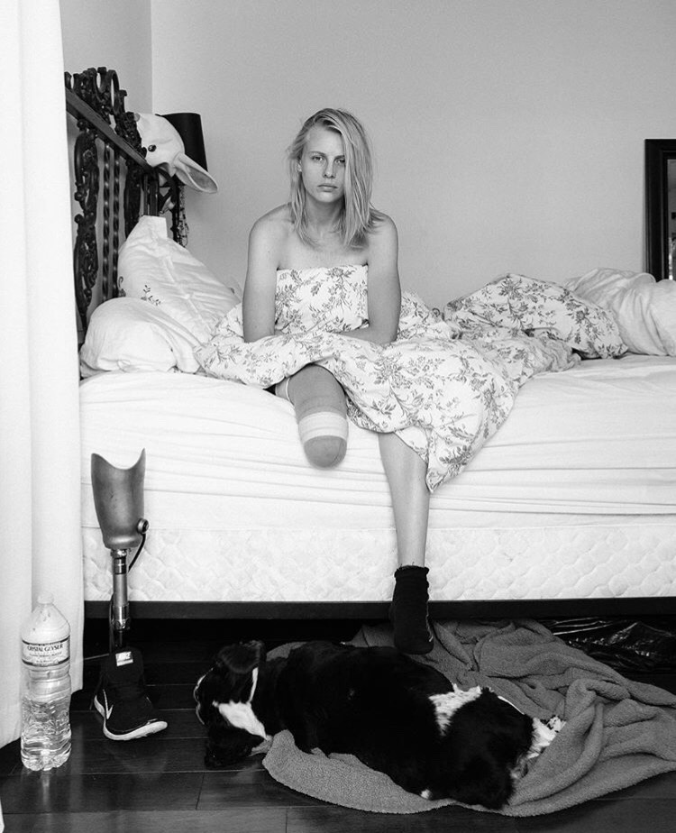 «Я готова к новой главе своей жизни»: модель Лорен Вассер перенесла ампутацию второй ноги